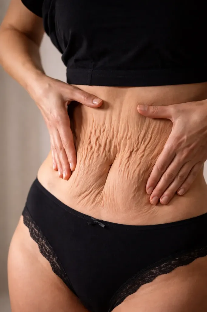 Fat Reduction + Body Contouring