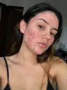 Acne Control & Skin Repair – 6 Sessions